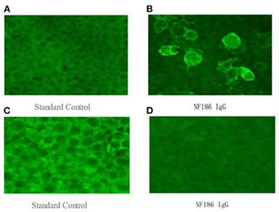 Case Report: Anti-NF186+ CIDP After Receiving the Inactivated Vaccine for Coronavirus Disease (COVID-19)